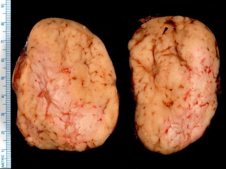 HodgkinsDisease_NodularSclerosis1(1)